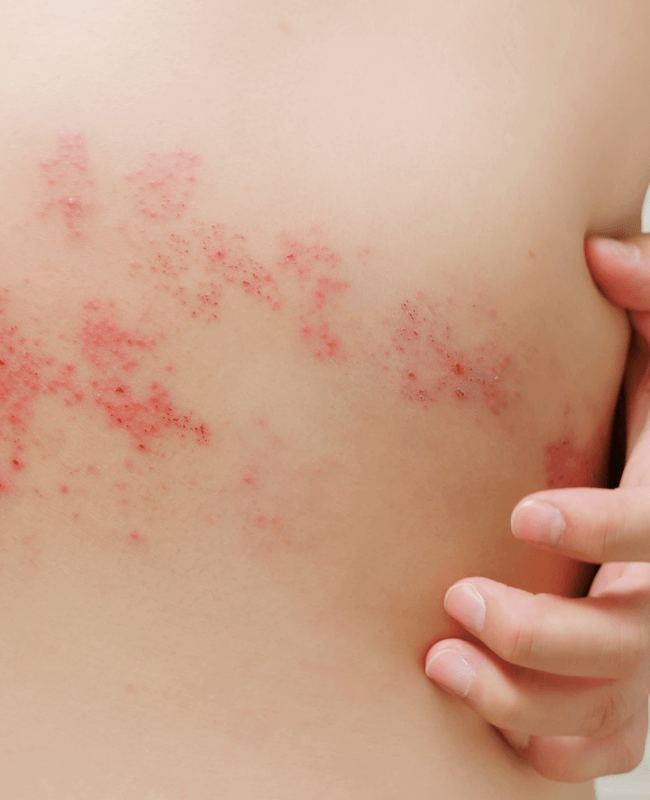 Hives - Causes, Symptoms, Treatment, Diagnosis 
